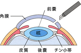 超音波水晶体乳化吸引術